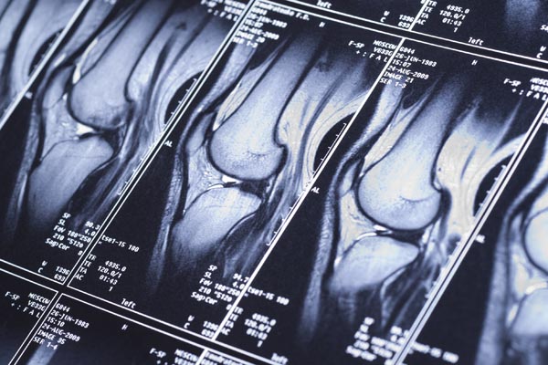 МРТ томограмма коленного сустава